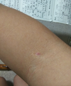 200913献血後の腕3ｈ後位